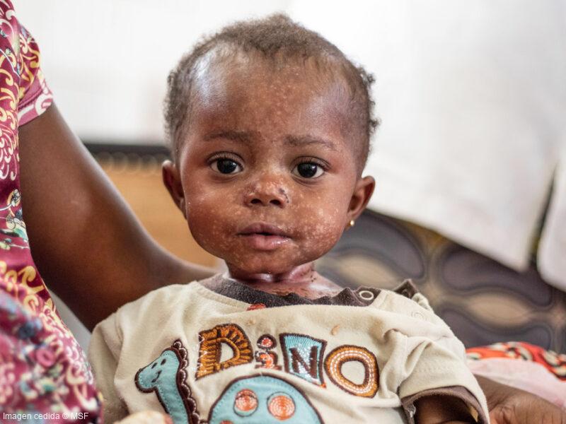 Vacunación por brote de sarampión en R.D. del Congo
